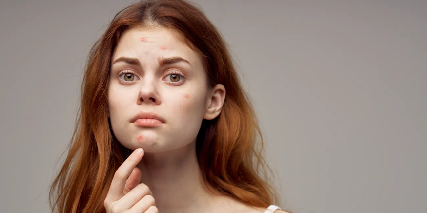 Do I Suffer From Genetic Acne? Find Out Here!